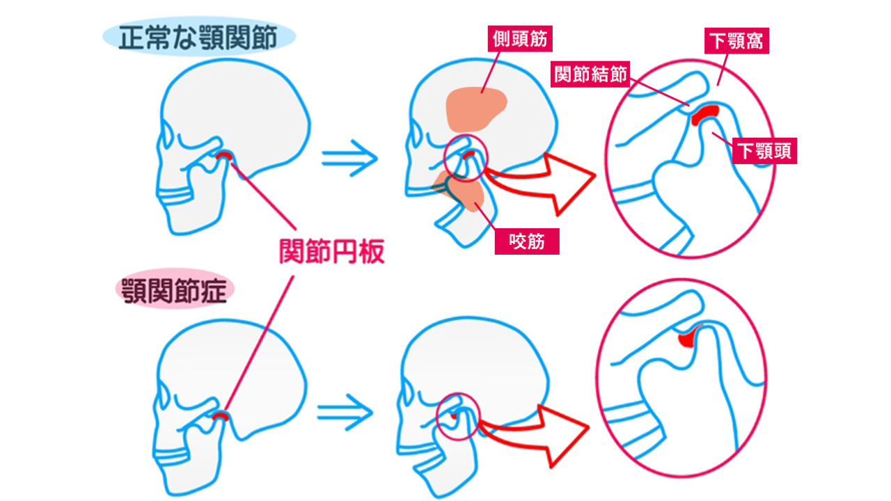 顎関節症