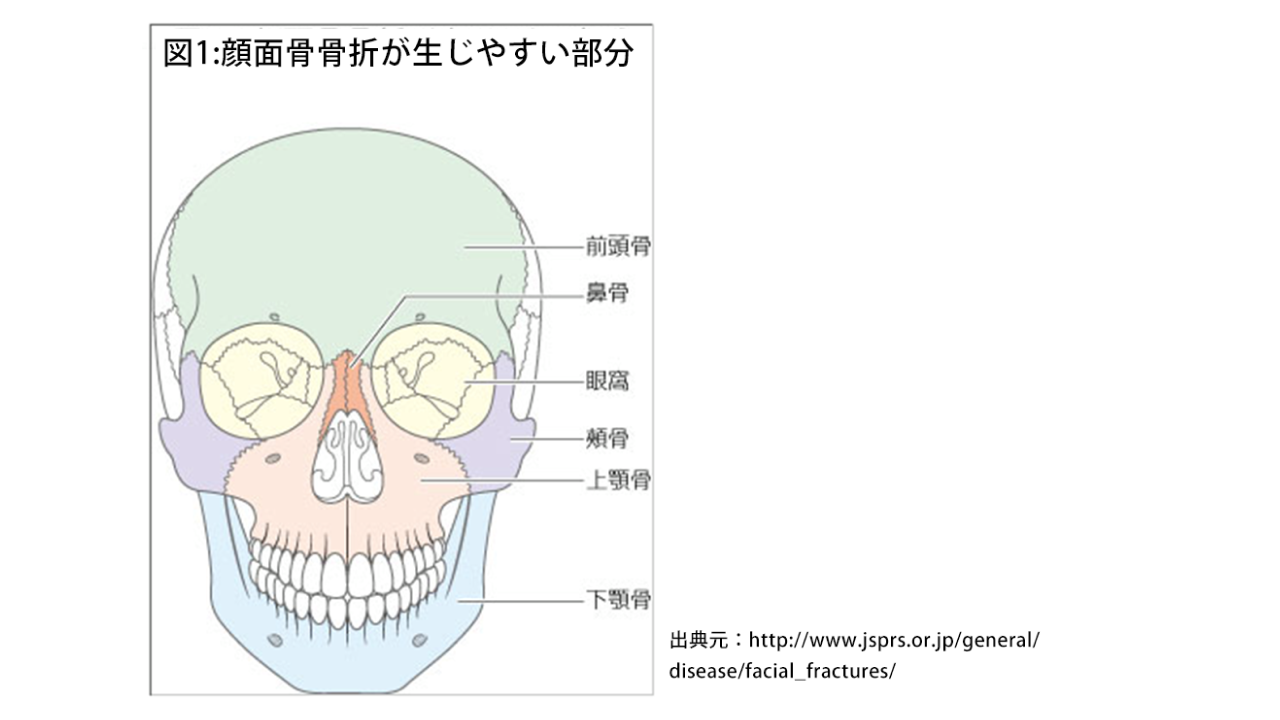 顔面骨骨折