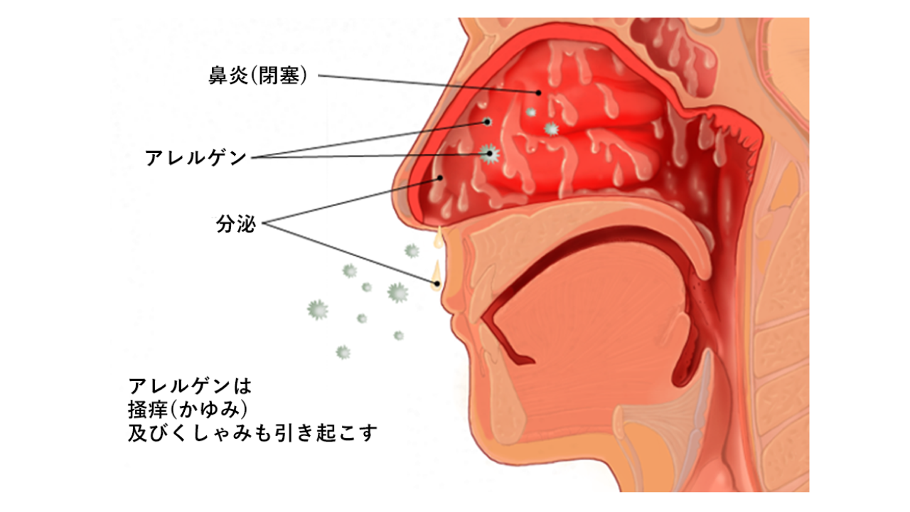花粉症・アレルギー性鼻炎