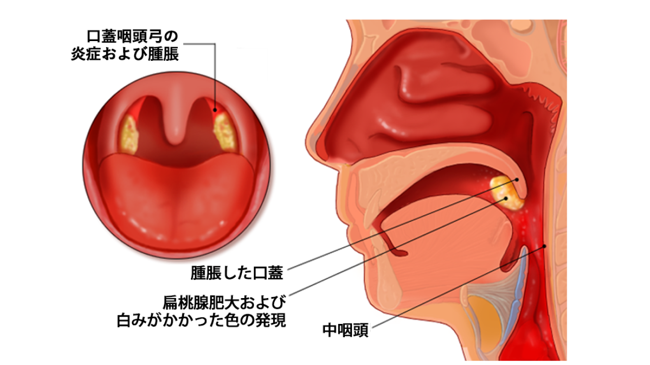耳鼻咽喉科で扱う感染症・炎症疾患とは？02