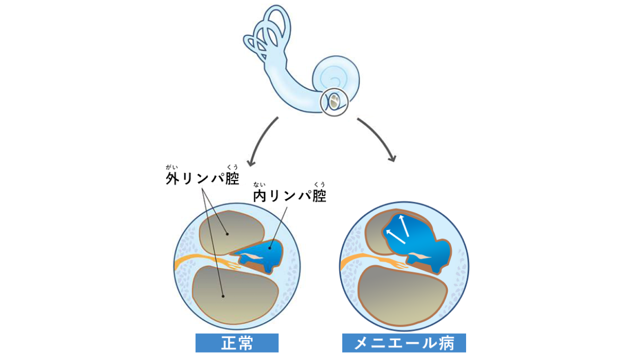 メニエール病02