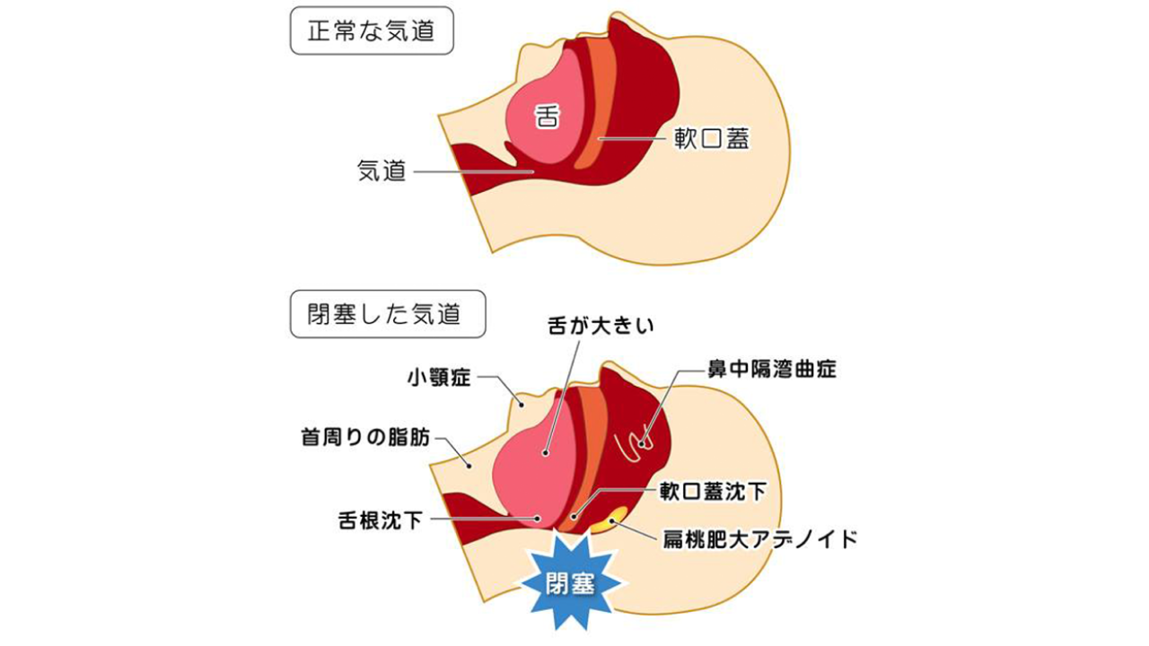 睡眠時無呼吸症候群
