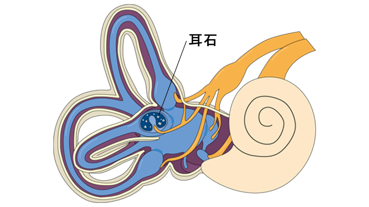 良性発作性頭位めまい症とは？02