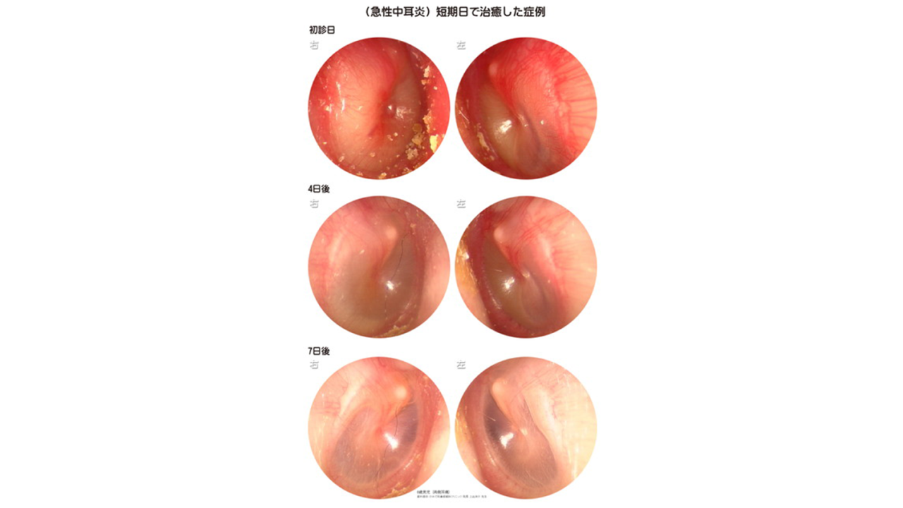 小児急性中耳炎01