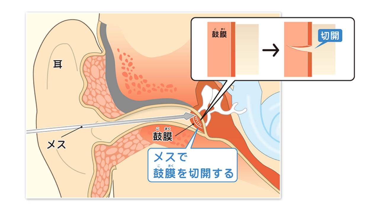 小児急性中耳炎02