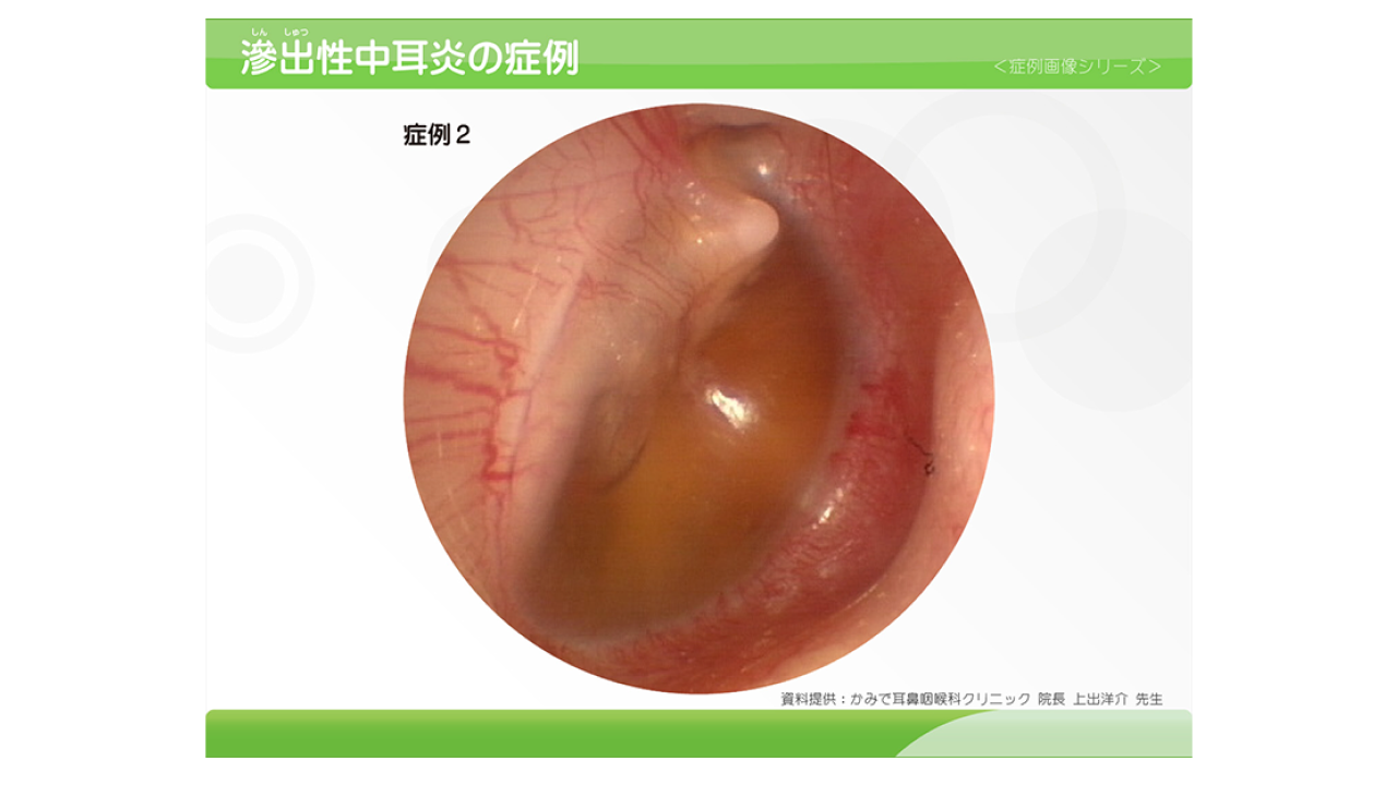 小児滲出性中耳炎01