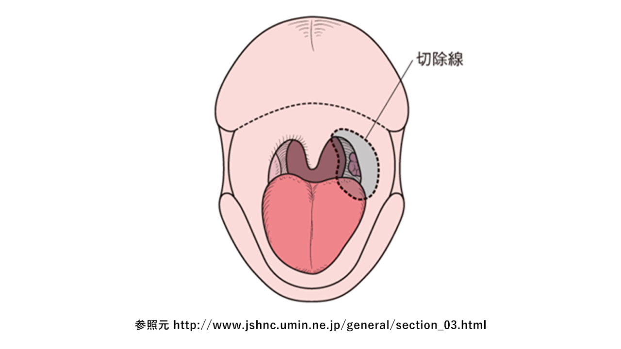 頭頸部癌01