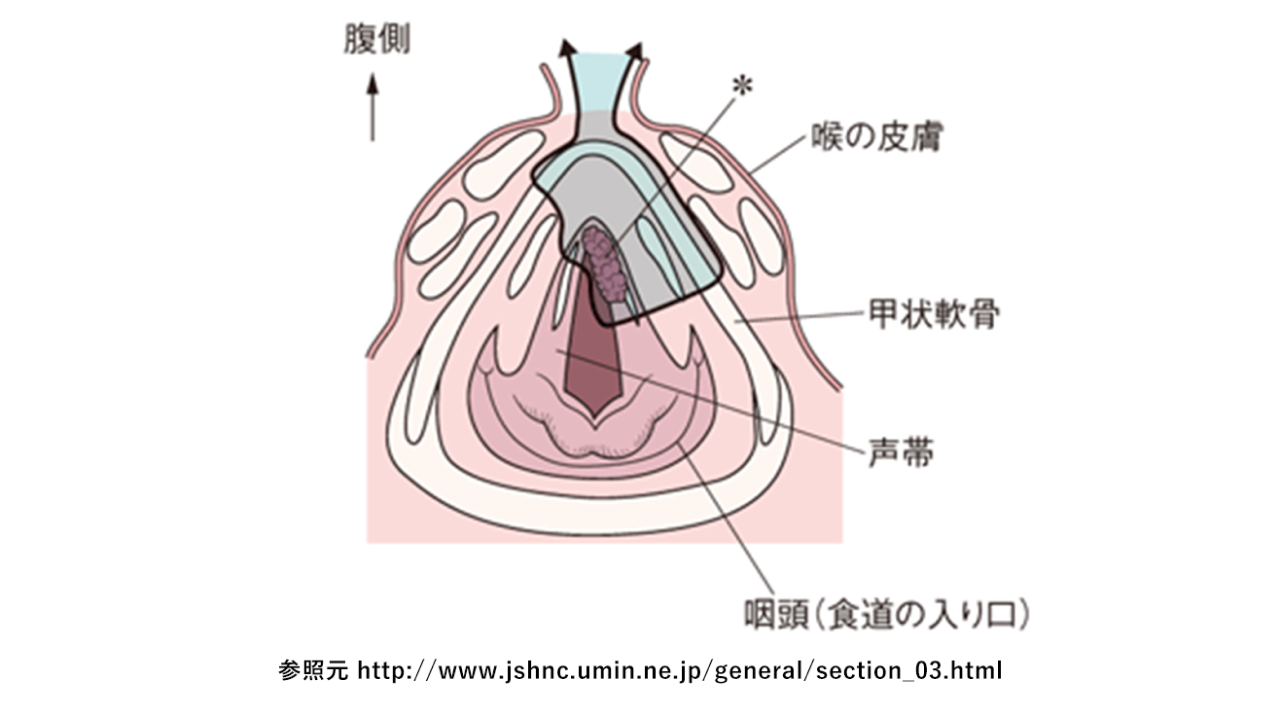 頭頸部癌02