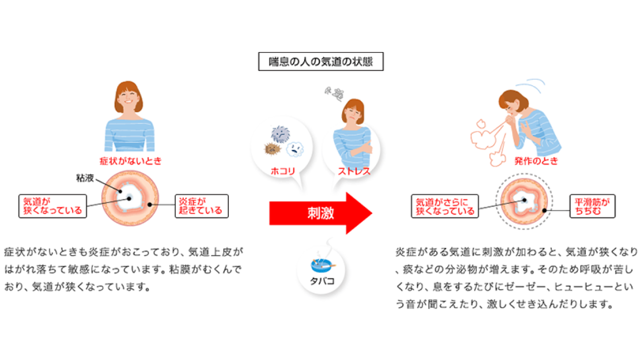 気管支喘息01